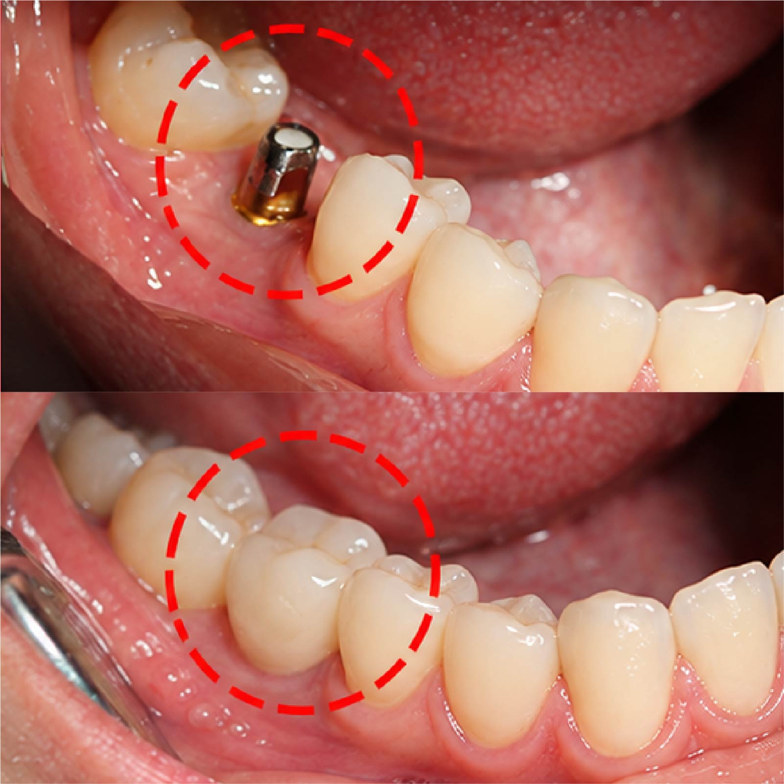 [CẦN BỔ SUNG: mô tả ảnh, ví dụ: Trước và sau cấy Implant răng hàm dưới, ca do bác sĩ Đặng Quốc Dũng điều trị]