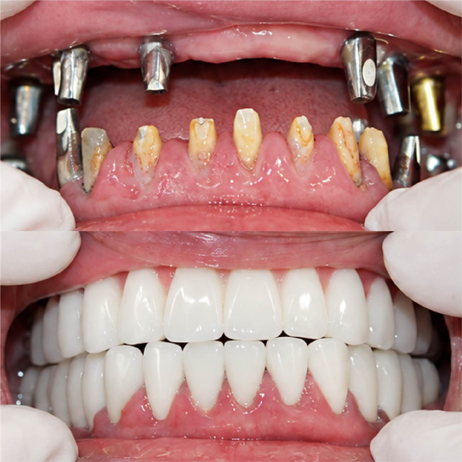 [CẦN BỔ SUNG: mô tả ảnh, ví dụ: Trước và sau cấy Implant răng hàm dưới, ca do bác sĩ Đặng Quốc Dũng điều trị]