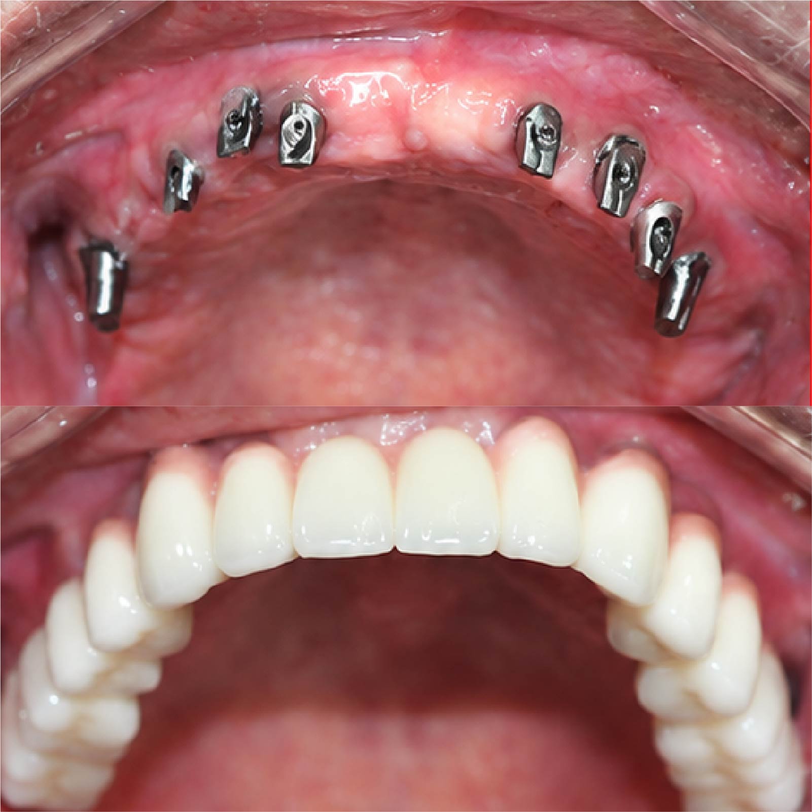[CẦN BỔ SUNG: mô tả ảnh, ví dụ: Trước và sau cấy Implant răng hàm dưới, ca do bác sĩ Đặng Quốc Dũng điều trị]