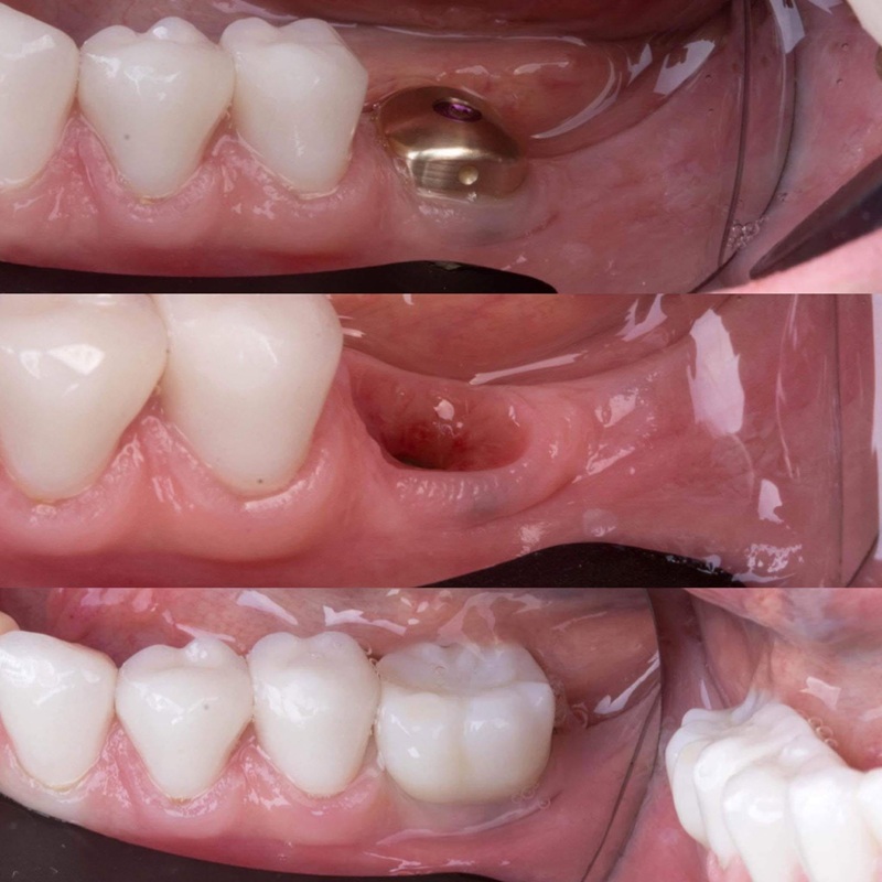 Áp dụng mọi trường hợp mất răng