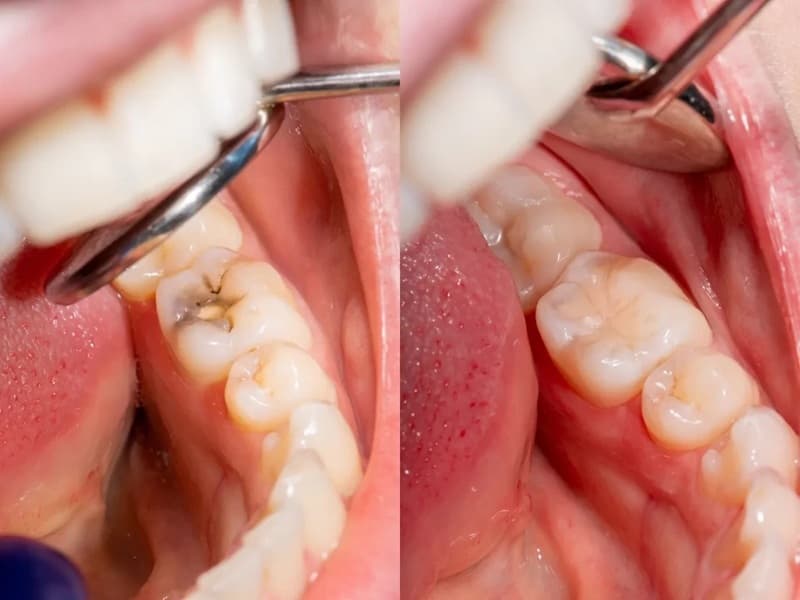 Áp dụng phương pháp trám răng cho trường hợp răng sâu sứt mẻ