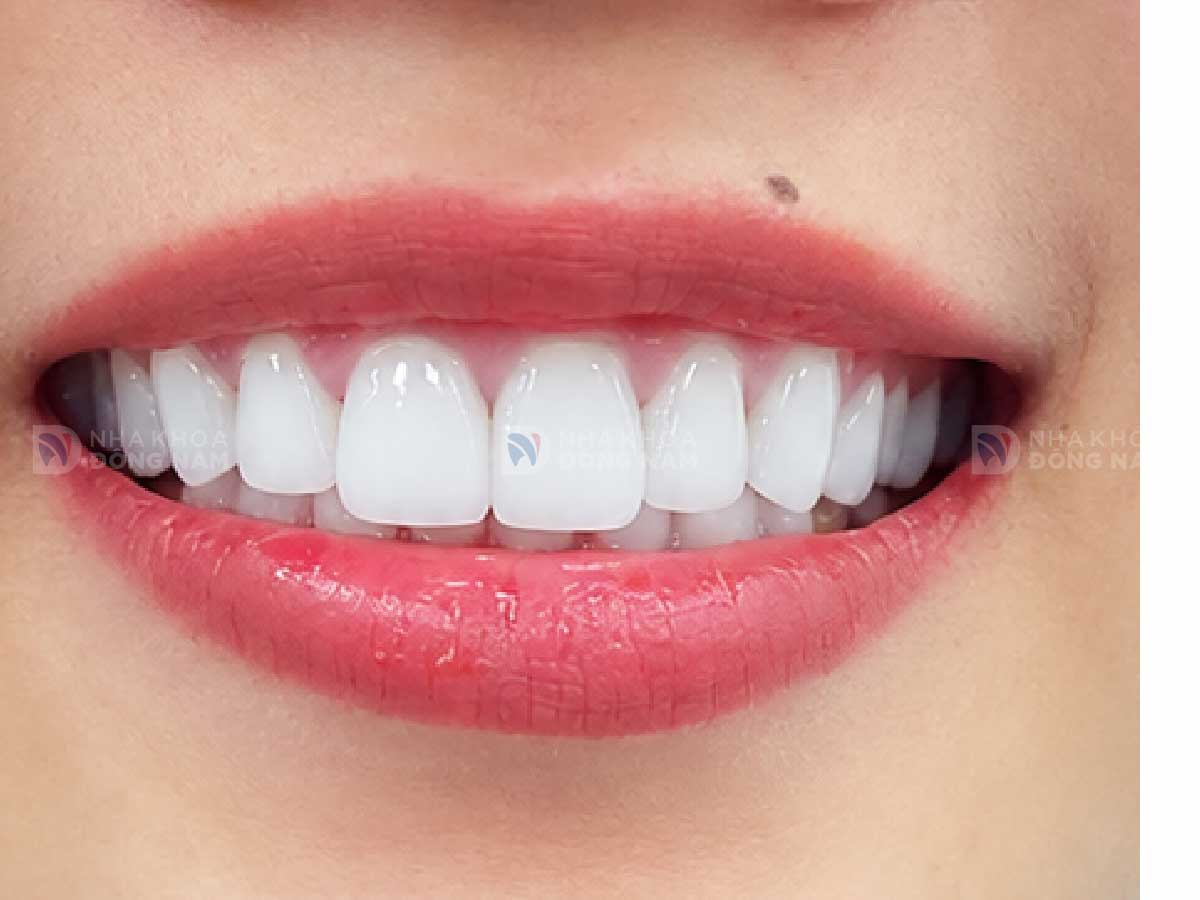 Sau khi bọc răng sứ: [mô tả kết quả ca 1]