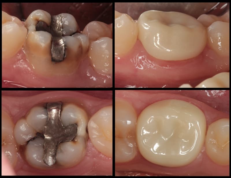 bọc răng sứ kim loại cho răng hàm bị sâu
