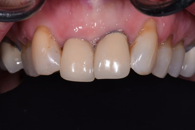 bọc răng sứ kim loại có thể xảy ra tình trạng đen viền nướu