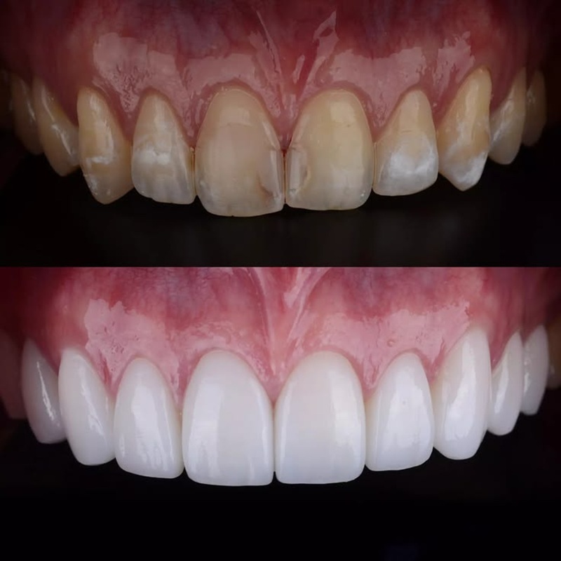 bọc răng sứ zirconia cho trường hợp răng ố vàng và hư tủy