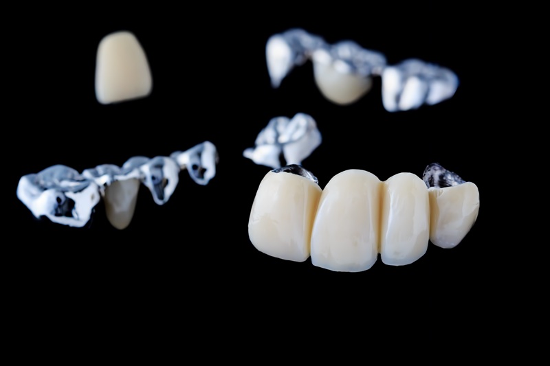 các dòng răng sứ titan được phân loại chủ yếu dựa vào xuất xứ vật liệu