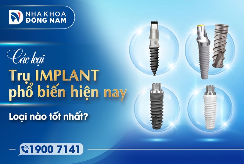 các loại trụ implant phổ biến hiện nay