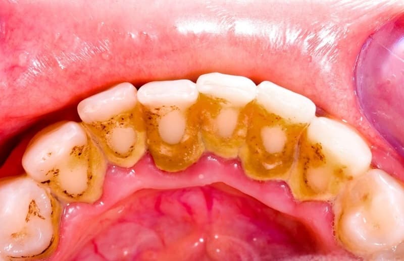 Cao răng là mảng bám đã bị khoáng hóa và trở nên cứng chắc