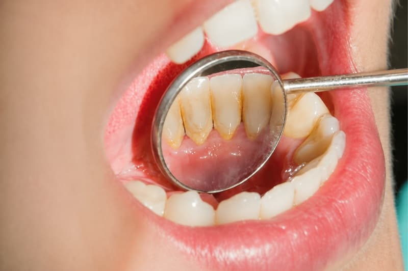 Cạo vôi răng khi thấy bề mặt răng xuất hiện mảng bám mà bàn chải không làm sạch được