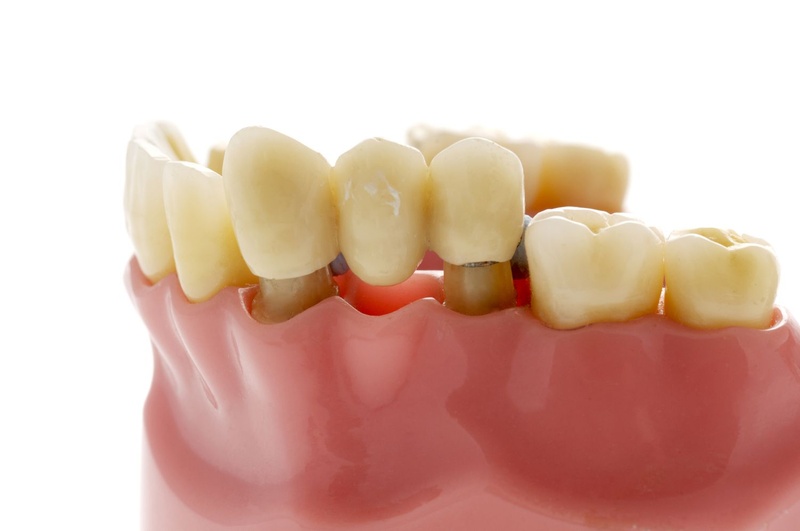cầu răng sứ cải thiện thẩm mỹ, ăn nhai tương đối tốt