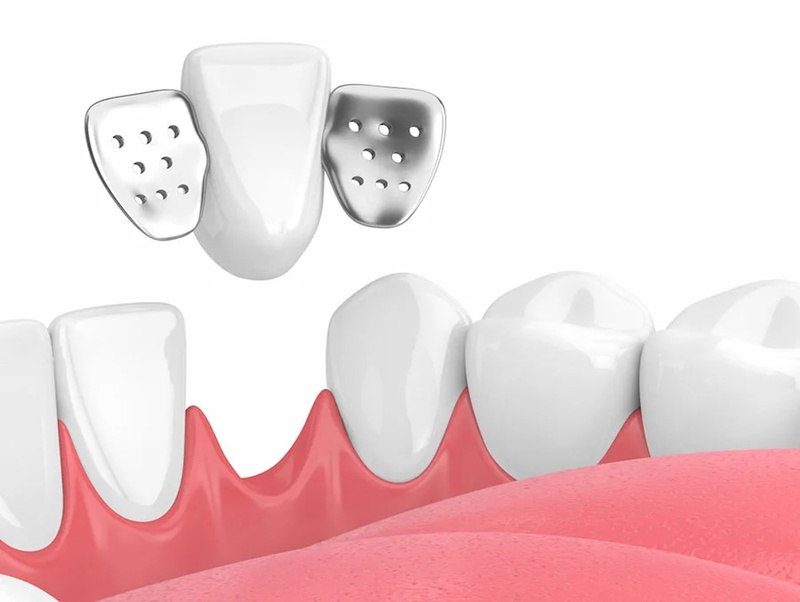Minh họa 3D cầu răng sứ cánh dán có cánh kim loại bám mặt trong răng kế cận