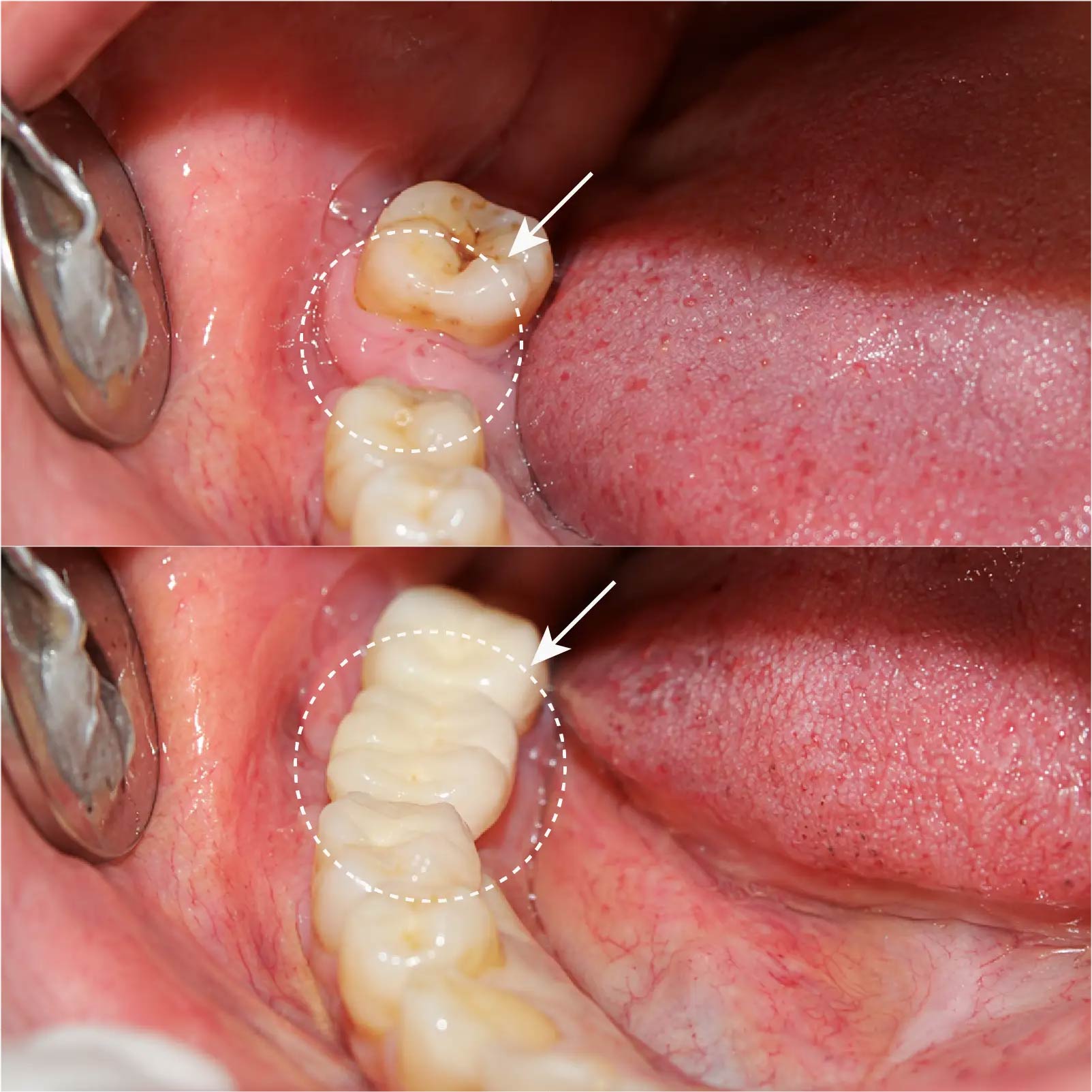 Hình ảnh trước và sau khi làm cầu răng sứ thay răng cửa bị mất tại Nha Khoa Đông Nam – ca 1