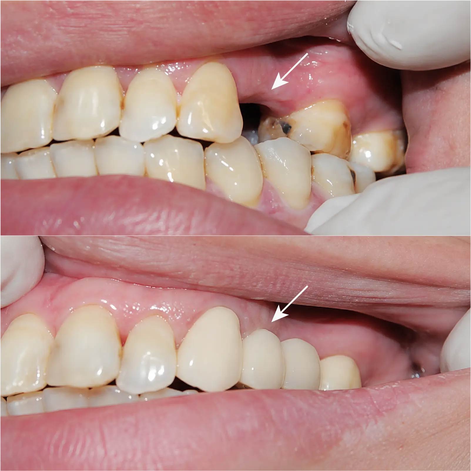 Hình ảnh trước và sau khi làm cầu răng sứ răng cửa 3 đơn vị tại Nha Khoa Đông Nam – ca 2