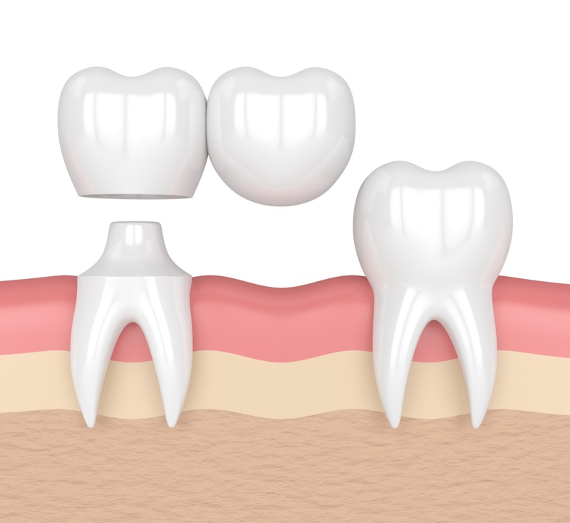 Minh họa 3D cầu răng sứ nhảy chỉ dùng 1 răng trụ ở một bên