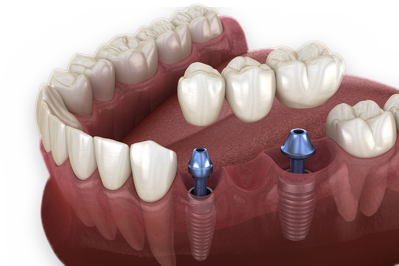 Minh họa cầu răng sứ trên trụ Implant không cần mài răng thật