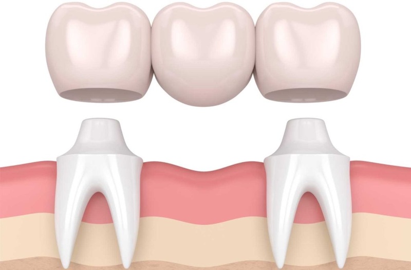 Minh họa cầu răng sứ truyền thống dùng 2 răng trụ hai bên