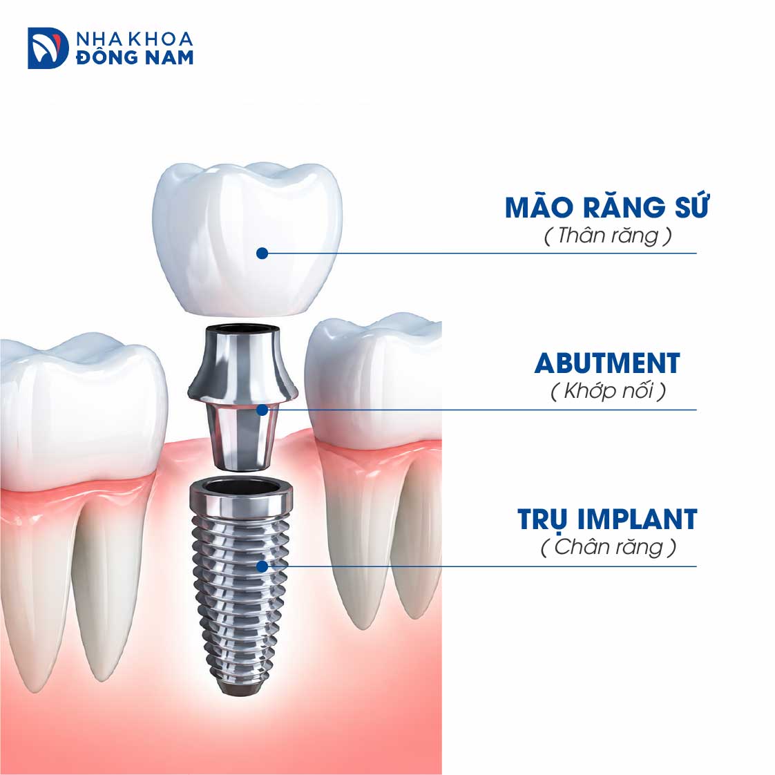 Cấu tạo răng Implant: trụ Implant trong xương hàm, khớp nối Abutment và mão sứ