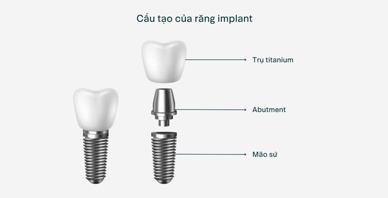 cấu tạo trụ implant gồm đầy đủ thân và chân răng như răng tự nhiên