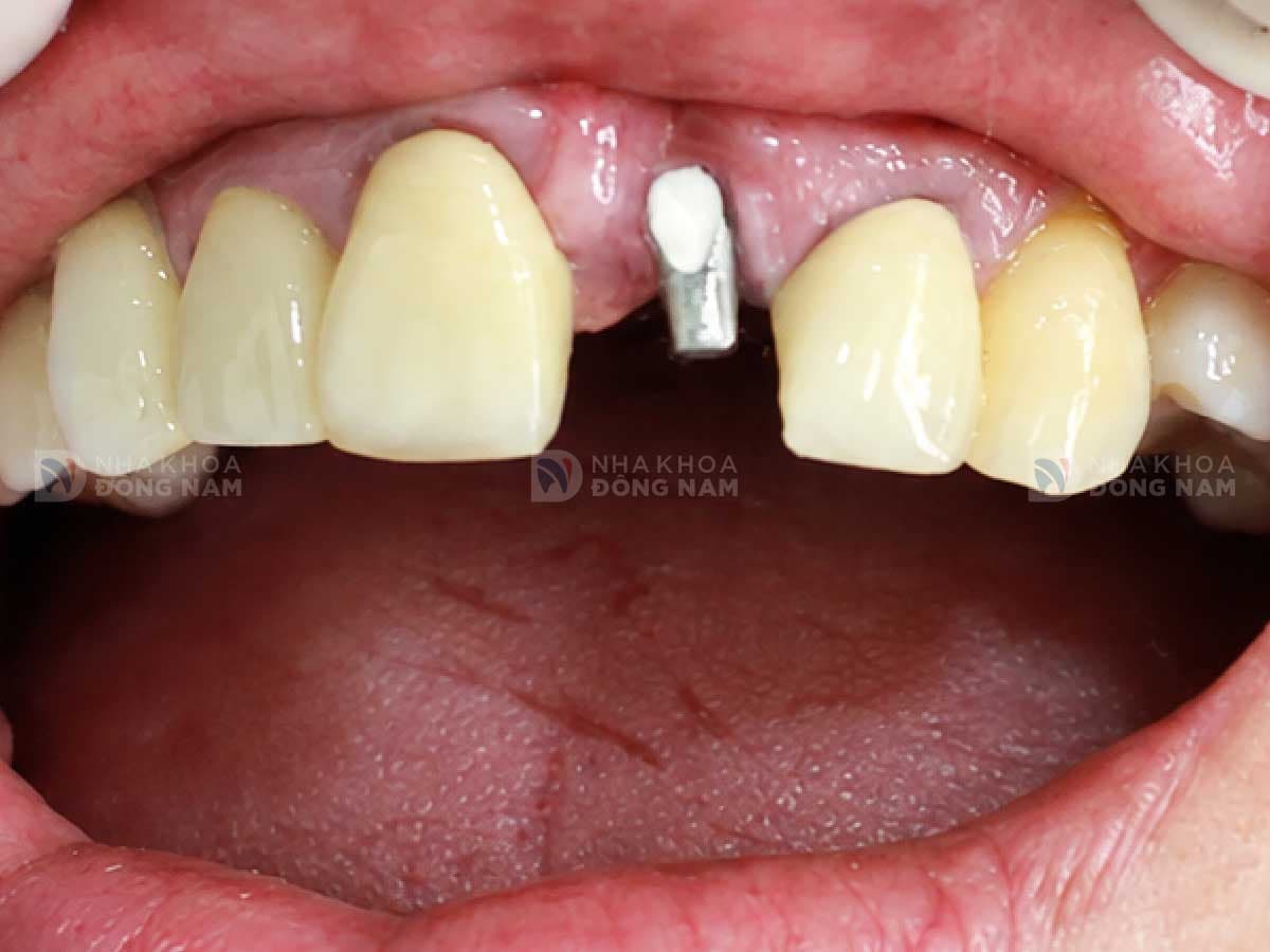 Trước khi trồng răng Implant: [mô tả tình trạng]