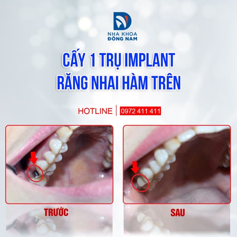 cấy 1 trụ implant biotem phục hình răng nhai hàm trên