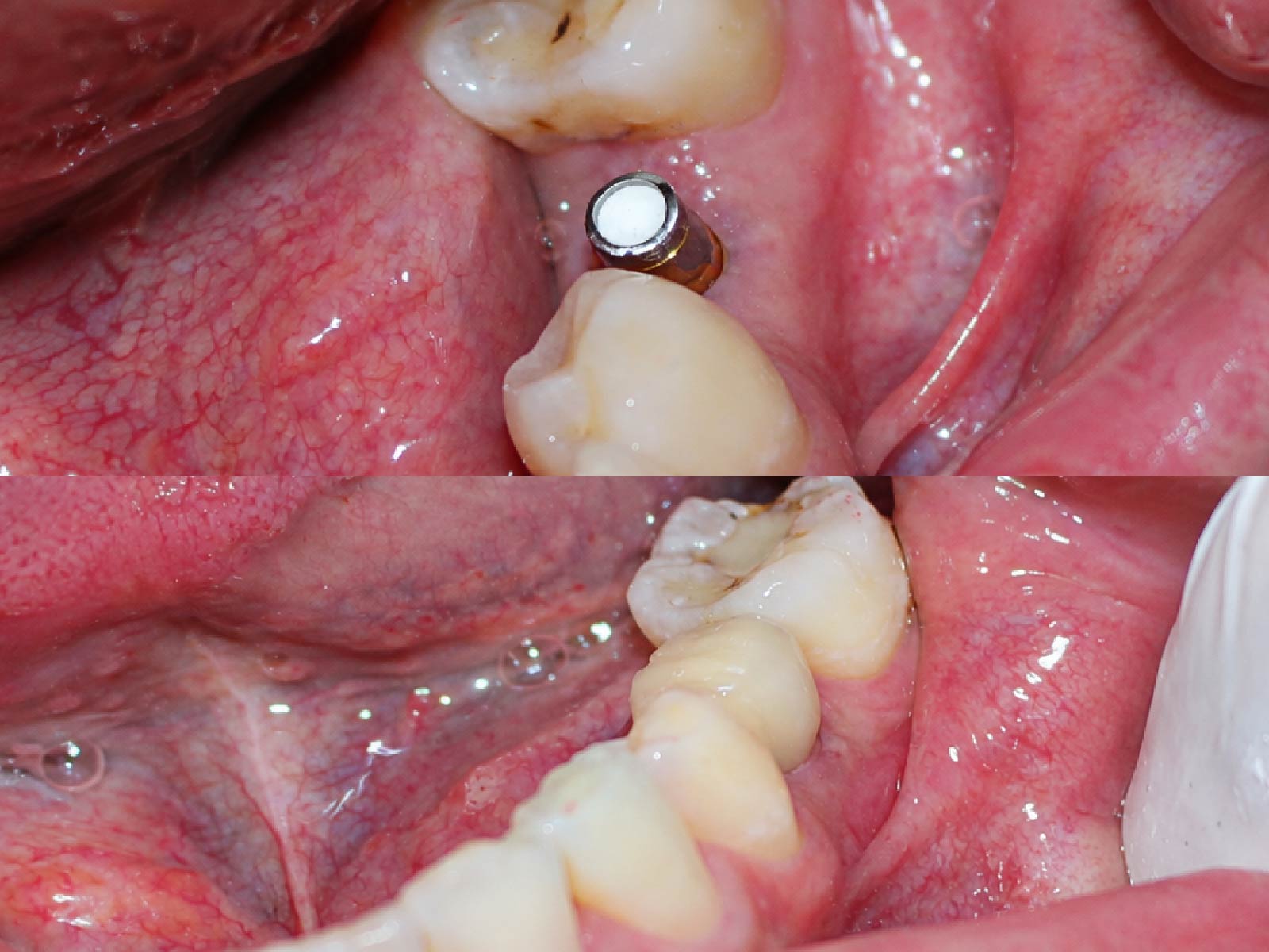 [CẦN BỔ SUNG: ví dụ: Trước và sau trồng răng Implant răng hàm dưới, ca do bác sĩ Nguyễn Phú Nhân điều trị]