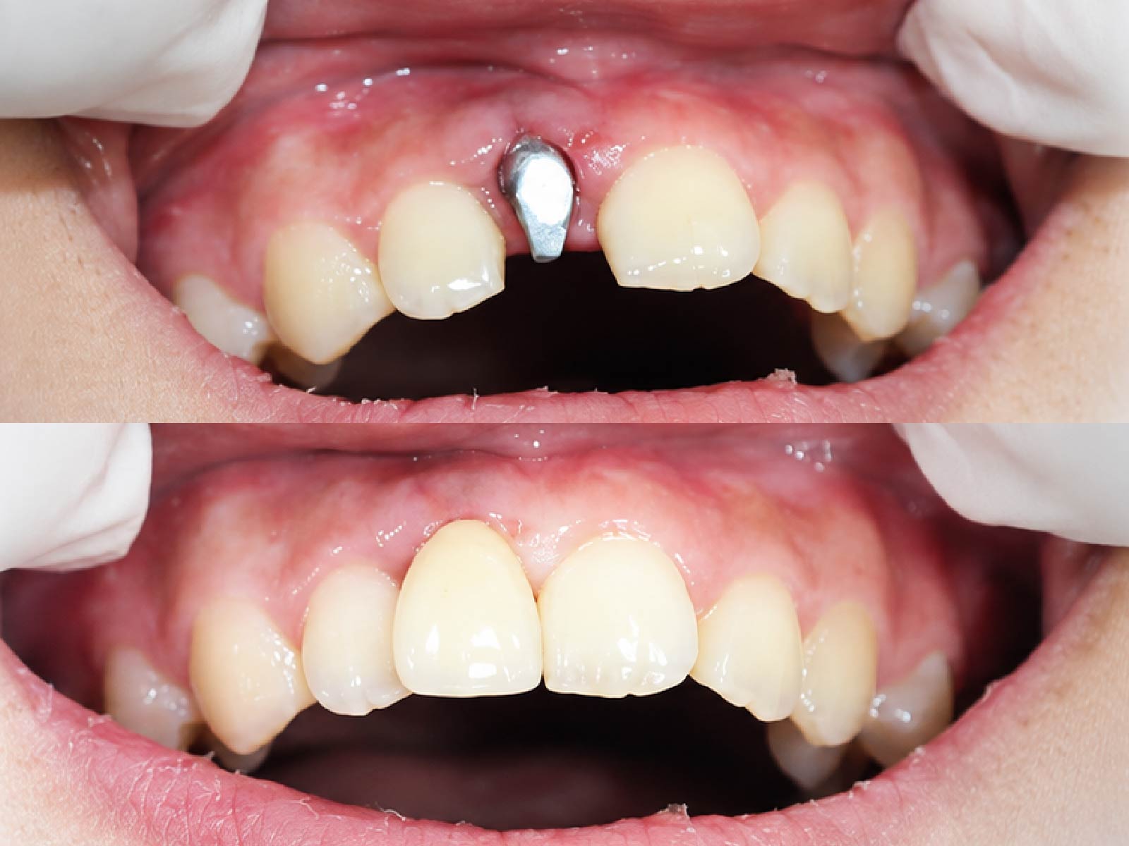 [CẦN BỔ SUNG: Trước và sau Implant toàn hàm All-on-4, ca do bác sĩ Nguyễn Thanh Long điều trị]