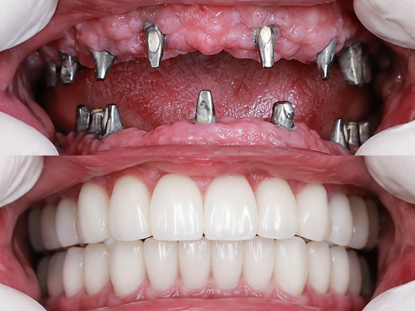 [CẦN BỔ SUNG: Trước và sau ghép xương, cấy Implant, ca do bác sĩ Nguyễn Thanh Long điều trị]