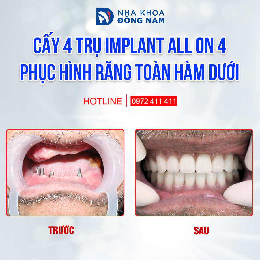 Cấy 4 trụ All-on-4 phục hình răng toàn hàm dưới