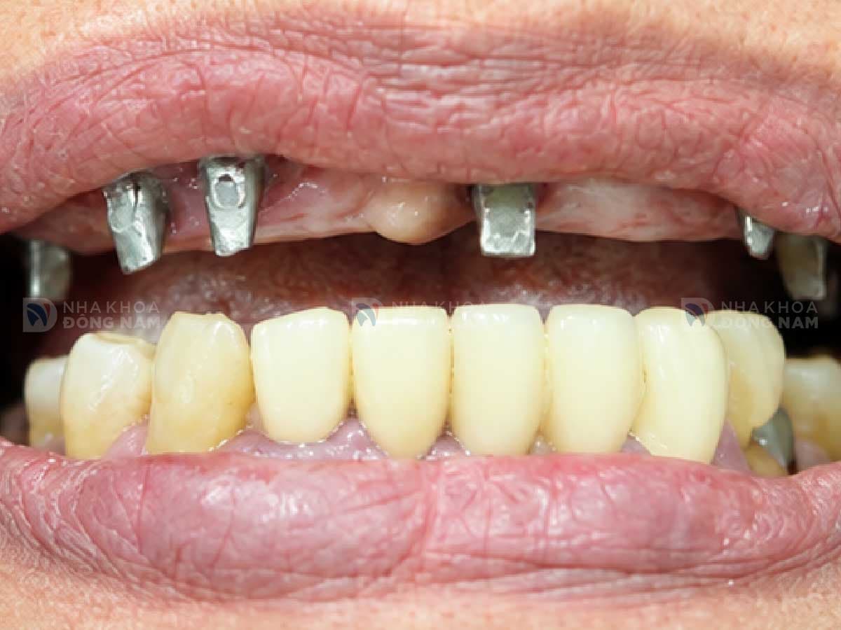 Trước khi trồng răng Implant răng cửa: [mô tả tình trạng]