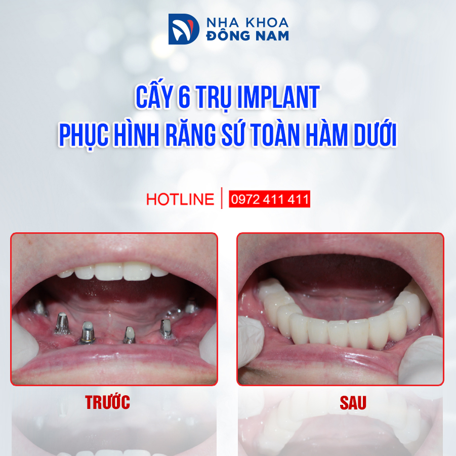 Cấy 6 trụ Implant phục hình răng sứ toàn hàm dưới