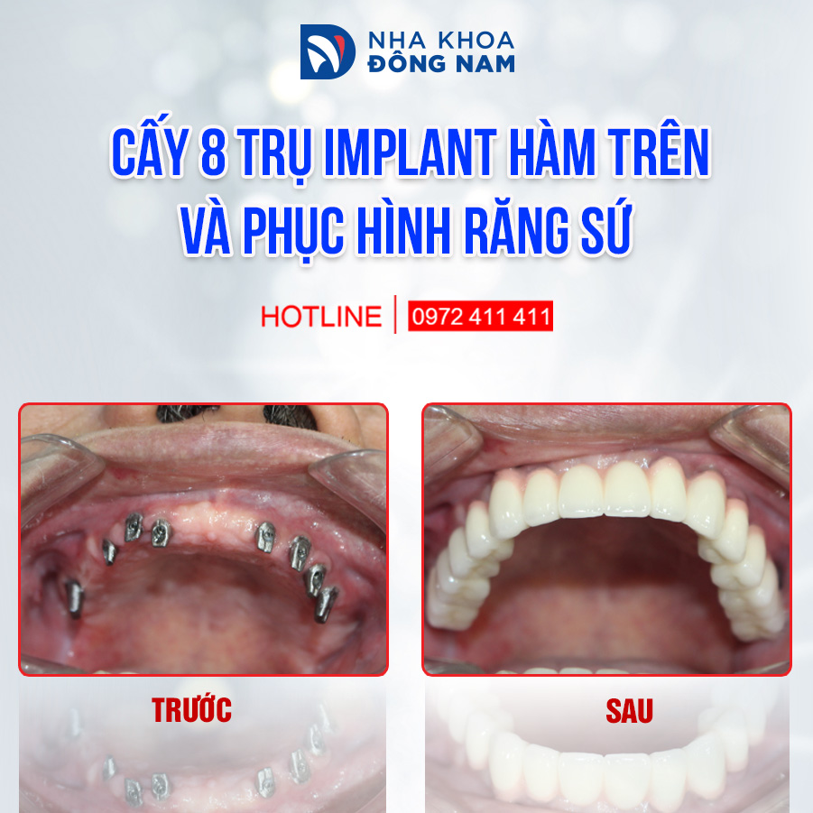 Cấy 8 trụ Implant hàm trên và phục hình toàn sứ