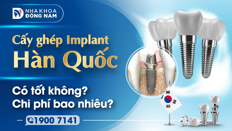 Cấy ghép implant hàn quốc có tốt không giá bao nhiêu