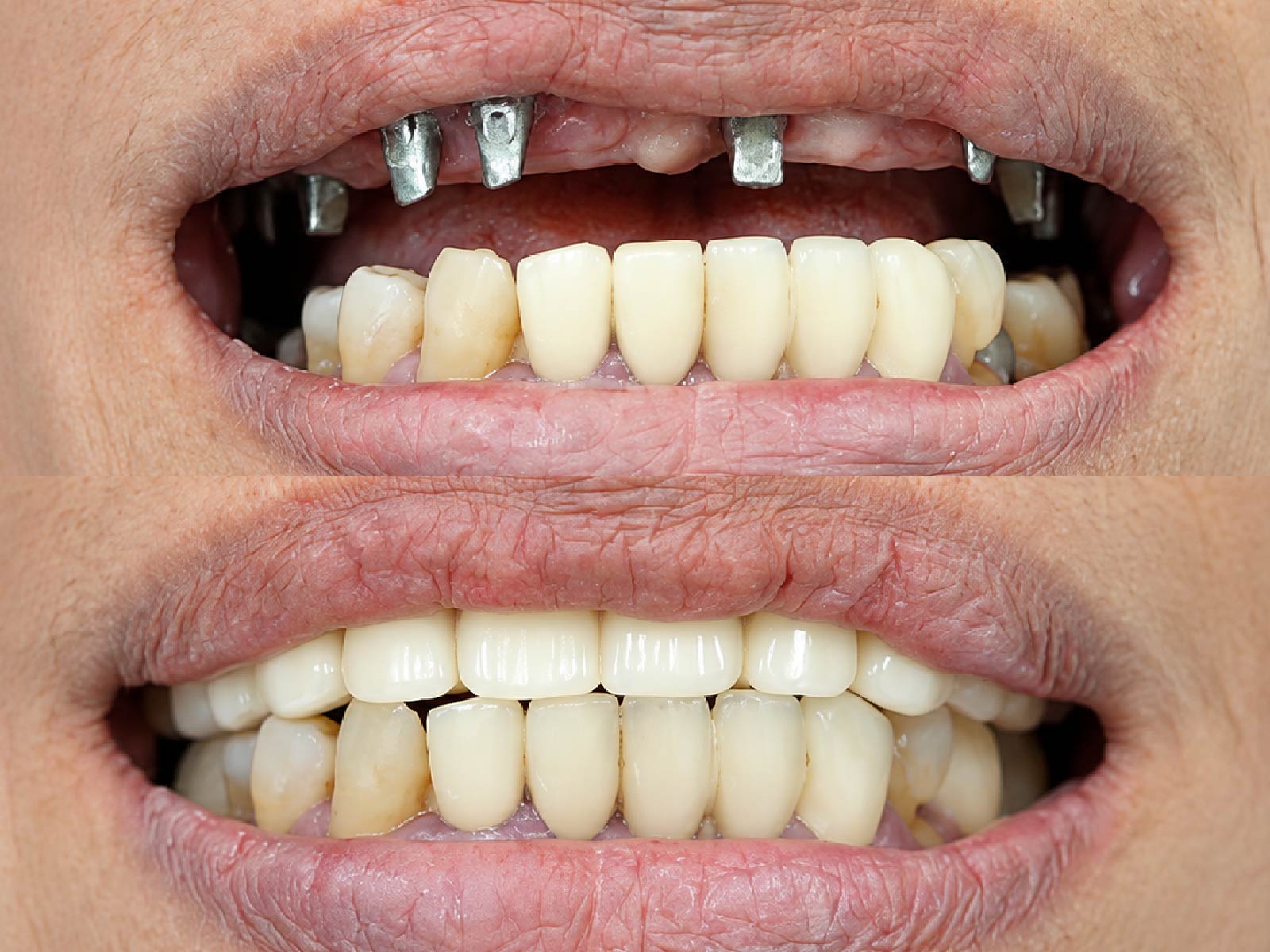 [CẦN BỔ SUNG: Trước và sau nâng xoang, cấy Implant hàm trên, ca do bác sĩ Nguyễn Thanh Long điều trị]