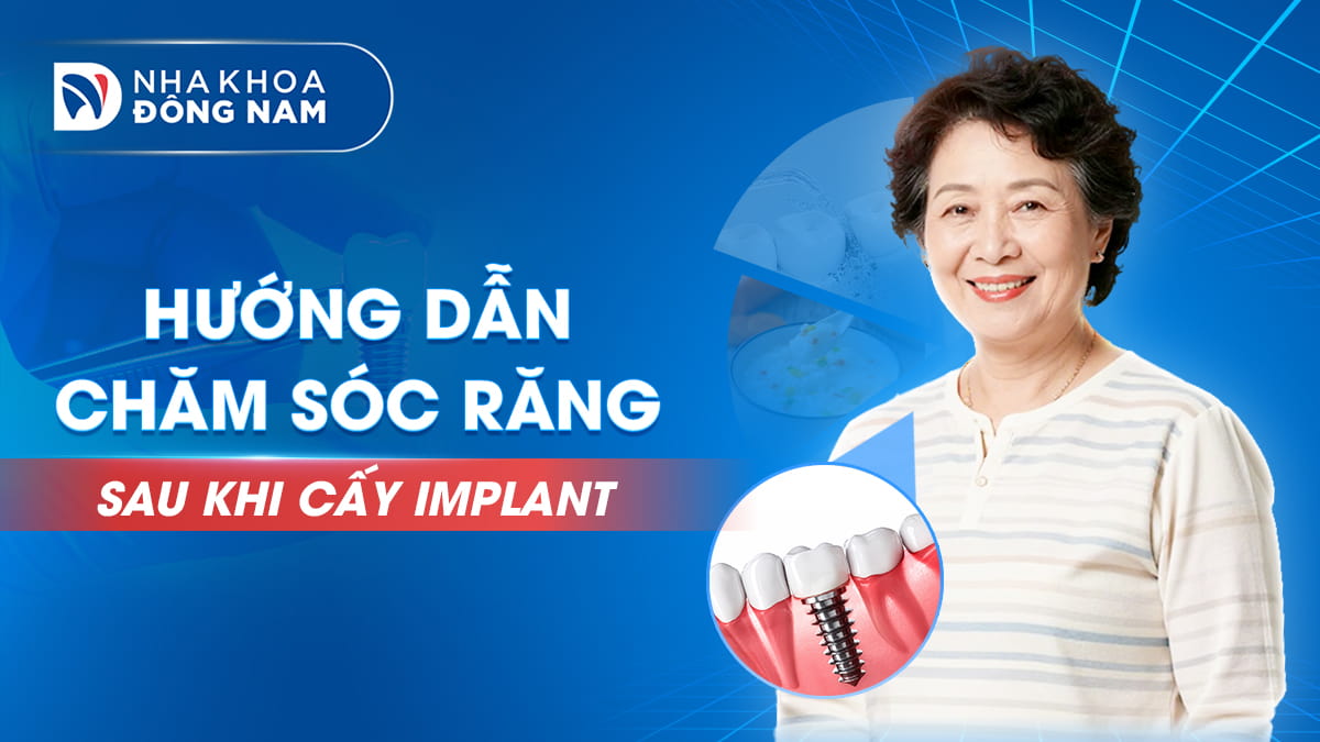 chăm sóc răng sau cấy implant