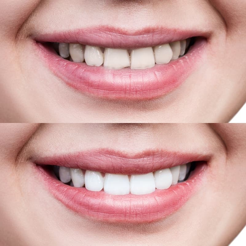 chi phí bọc răng sứ phụ thuộc vào vị trí và số lượng răng sứ cần phục hình