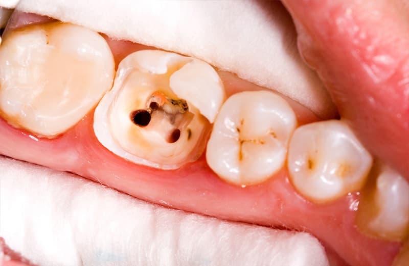 chi phí trám răng phụ thuộc vào mức độ và số lượng răng cần trám