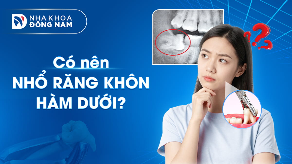 có nên nhổ răng khôn hàm dưới