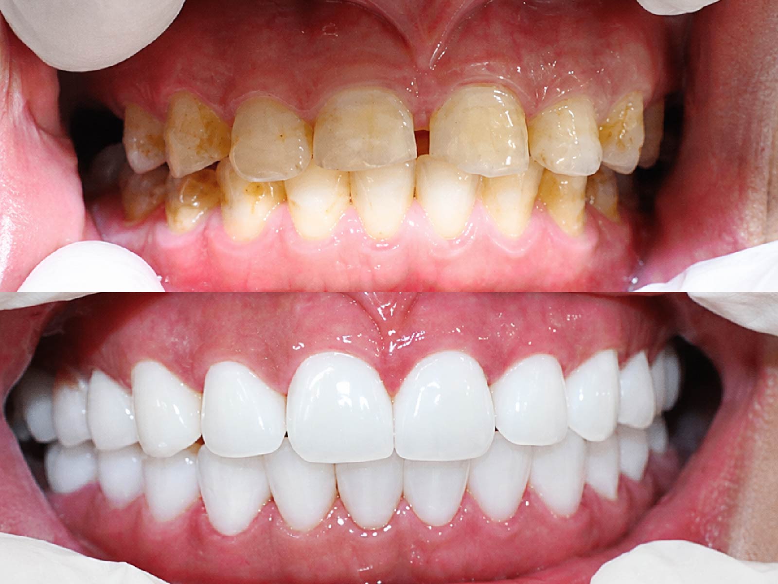 [CẦN BỔ SUNG: ví dụ: Trước và sau bọc răng sứ răng cửa, ca do bác sĩ Nguyễn Phú Nhân điều trị]