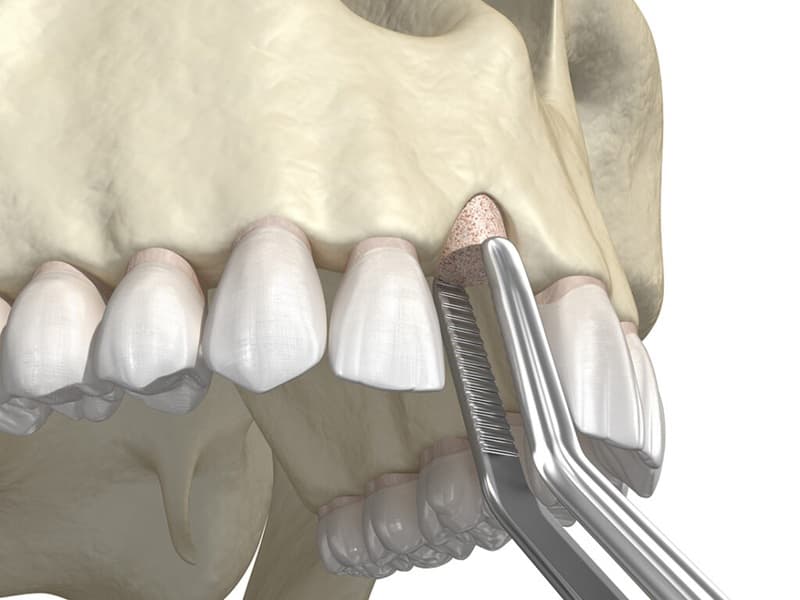 ghép xương khối để tái tạo hình dạng sống hàm