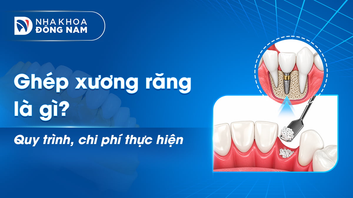 ghép xương răng là gì quy trình chi phí