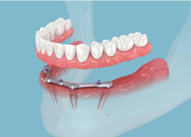 Hàm tháo lắp trên implant