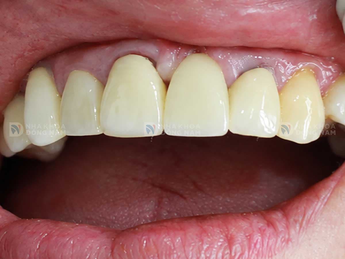 Sau khi trồng răng Implant: [mô tả kết quả]