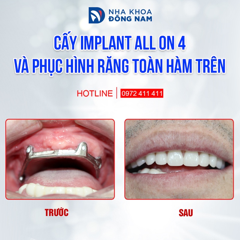 Implant All-on-4 cho bệnh nhân mất răng toàn hàm tiêu xương nhiều