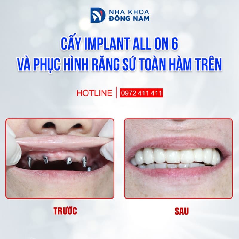 implant mỹ đảm bảo thẩm mỹ và ăn nhai như răng thật