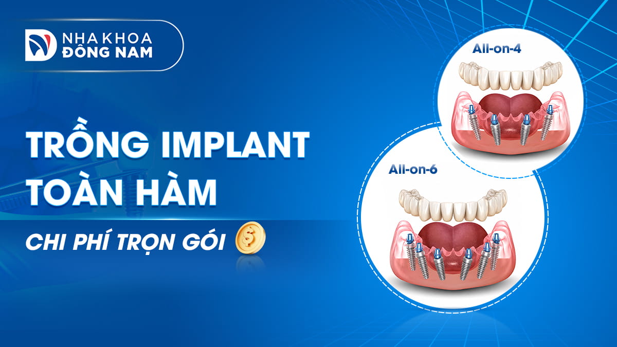 implant toàn hàm chi phí trọn gói