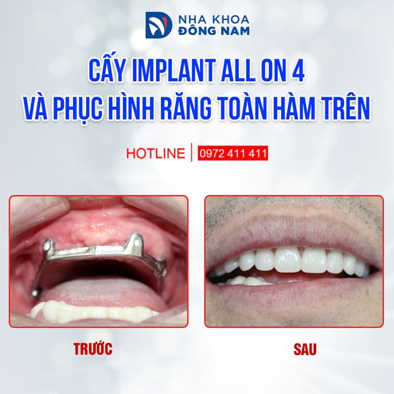 implant toàn hàm giúp phục hồi ăn nhai, hạn chế tiêu xương và mang lại nụ cười tự nhiên