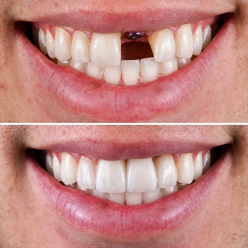khách hàng lấy lại nụ cười rạng rỡ nhờ cấy ghép implant