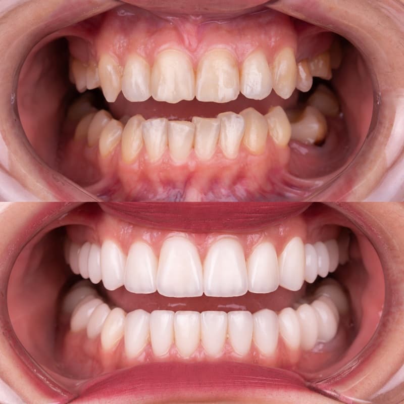 không chỉ thẩm mỹ mà răng sứ lava plus còn đảm bảo chức năng ăn nhai như răng thật