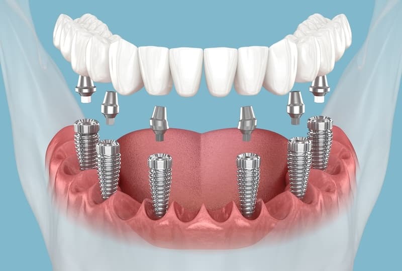 kỹ thuật all on 6 với 6 trụ implant phân bố đều từ vùng răng cửa đến răng hàm giúp phân tán lực nhai