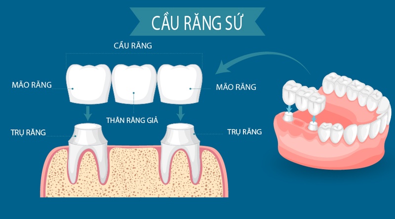 Cấu tạo cầu răng sứ gồm mão răng trên 2 trụ răng và thân răng giả ở giữa